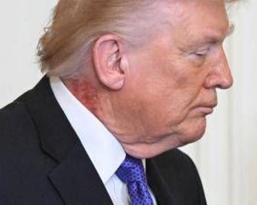 Trump e il collo arrossato, la foto riaccende i dubbi sulla salute del presidente